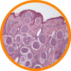 Microscopic enlargement of Besnoitiosis